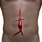 Abdominal Aortic Aneurysm – A Silent Killer – Is Detectable With Ultrasound
